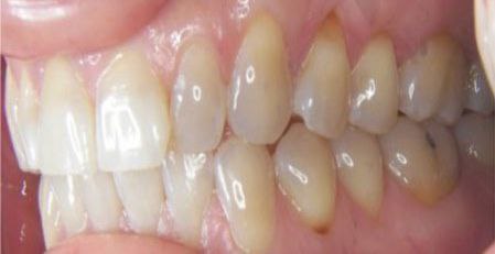 Клиновидный дефект зубов: причины, методы лечения